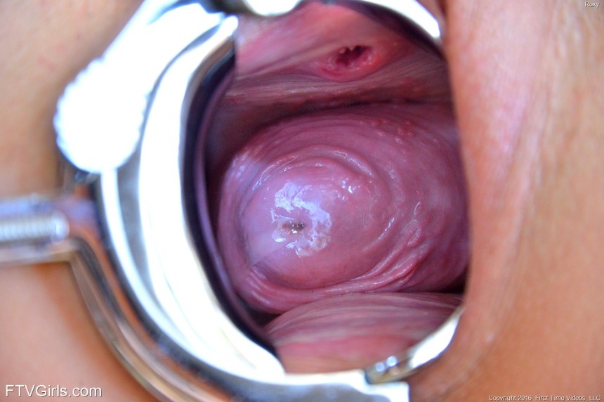 Yeast infection cervix speculum close up amateur